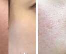 美肌へ肌悩みのカウンセリング➕肌改善方法教えます プロ資格講師自宅ケア改善指導ニキビ肌荒れ改善法伝授 イメージ3