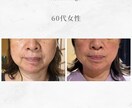 顔に鍼を打ってるだけ”から卒業できます お客様に変化を実感させる美容鍼の基礎からの打ち方 イメージ3
