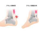 アキレス腱を断裂した方の不安解消します 断裂したばかりで不安いっぱいの方、話聞きます。 イメージ1