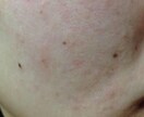 肌のお悩みの相談乗ります 肌荒れ、乾燥肌、毛穴がきになる方へ イメージ3