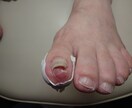 写真でわかる巻き爪診断｜巻き爪専門がチェックします 今の状態が良いのか治療を必要とするのか具体的に説明致します。 イメージ3