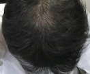 薄毛の方に朗報。私が改善した体験談をお伝えします 男性専用となります。特に頭頂部が薄い方はご相談下さい。 イメージ3