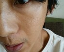 ニキビに悩む皆様にアドバイスします 若いときニキビに悩んだ経験を今悩んでる彼方にアドバイスします イメージ2