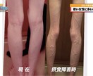 摂食障害の悩みを乗り越えられるよう寄り添います 163cm25kgを克服してCAになった相談員がサポート イメージ2
