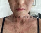 誰にも話せないアトピーの悩み聞きます経験談話します 20年間アトピーに悩み脱ステロイドを経験し、改善したOLです イメージ2