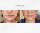 顔に鍼を打ってるだけ”から卒業できます お客様に変化を実感させる美容鍼の基礎からの打ち方 イメージ1