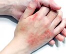 肌荒れの相談のります 試行錯誤を繰り返した私の皮膚科要らず治療法伝授！ イメージ1