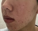 実際の経験をもとにアドバイスします 一緒にニキビの原因を分析していきましょう！ イメージ1