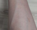 剛毛の方でも綺麗に脱毛できます 半額でできます。3カ月に1回くらいで通えばオッケーです。 イメージ2