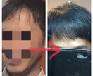 期間限定！30歳若ハゲの激安克服方法を教えます 若ハゲの悩みを持つ20代から40代の方へ イメージ1