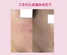 ニキビ肌を克服した私がやって良かったことを教えます 実際にやってよかったことなど、私の経験をありのまま伝えます。 イメージ1