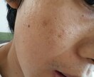 ニキビに悩む皆様にアドバイスします 若いときニキビに悩んだ経験を今悩んでる彼方にアドバイスします イメージ3
