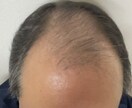 植毛について、実体験に基づきアドバイスします 育毛剤、頭皮ケアはほぼ無意味！AGA治療薬は一生継続必要 イメージ3