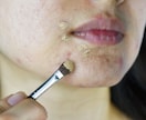 炎症ニキビを体の中から改善します 皮膚科も効かない方のための根本ケア イメージ2
