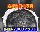 植毛について、実体験に基づきアドバイスします 育毛剤、頭皮ケアはほぼ無意味！AGA治療薬は一生継続必要 イメージ1
