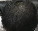 薄毛の方に朗報。私が改善した体験談をお伝えします 男性専用となります。特に頭頂部が薄い方はご相談下さい。 イメージ5