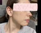 赤ら顔、脂漏性湿疹の経験の改善点お伝えします 気をつけたことや具体的なスキンケア製品等をお伝えします。 イメージ3
