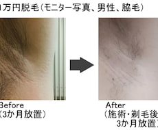 いいねで開始！脱毛器、当て方も含めレクチャーします 機器の入手方法から、実際に使用しながら使用法のレクチャーまで
