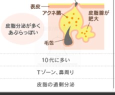 思春期ニキビの改善方法を提案します イメージ1