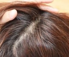 育毛は「頭皮」で決まる。見直すべき頭皮の事話します 抜け毛、薄毛の本当の話を発毛サロンの私の話を聞いてください