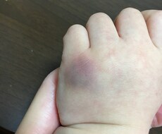 血小板減少性紫斑病になったら…お教えします イメージ1