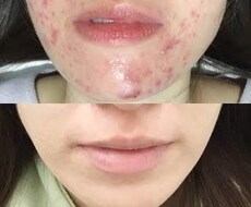 治らないニキビ！落ち着く方法教えます イメージ1