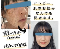 アトピーや敏感肌でお悩みの方、お話聞きます イメージ1