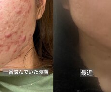 皮膚科で治らないニキビを改善した方法をお伝えします イメージ1