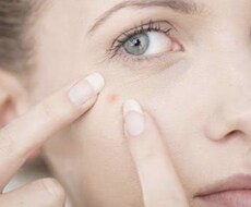 二十代女性必見！ニキビの出来にくい体質へと導きます イメージ1