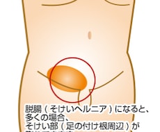そけいヘルニアに関するご相談に専門医がお答えします イメージ1