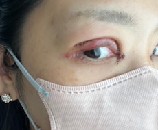 眼瞼下垂（二重整形）手術後の合併症　後遺症相談ます 2年半の生活変化と私の乗り越え方