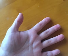 手荒れの相談のります ようやく14年目で手荒れが克服できました