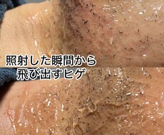 ヒゲ脱毛で結果を出せてないオーナー様救います イメージ1