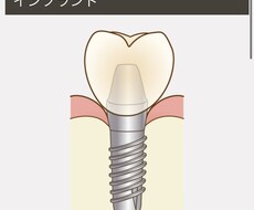国立大卒歯科医がインプラント相談に乗らせて頂きます イメージ1