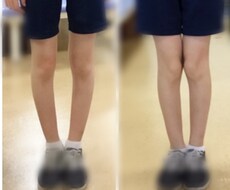 O脚は修正できますます イメージ1