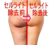 悪魔のセルライトは絶対イヤという方にオススメします イメージ1