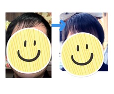 発毛経験、プロペシアの使用体験教えます イメージ1