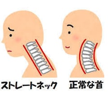 スマホ首必見！ストレートネックの解消法を教えます イメージ1