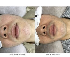 脱毛体験を話します イメージ1