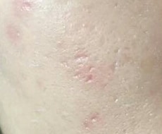 家でクレーターを完全に治す方法教えます イメージ1