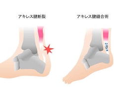 アキレス腱を断裂した方の不安解消します イメージ1