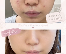 オープン記念¥1,500♡美肌になる方法教えます 30代のニキビ、ニキビ跡悩みさん必見！すっぴんがキレイになる