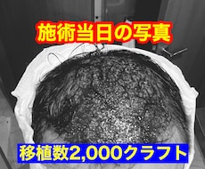 植毛について、実体験に基づきアドバイスします イメージ1