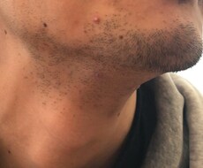 ヒゲ脱毛の経験を余すことなくお伝えします イメージ1
