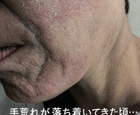 くり返す肌荒れ経験者がその苦しさ受けとめます ずっとくり返す、なんで私だけ? もうイヤ!! イメージ2