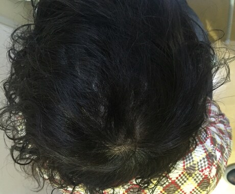 男性お悩みのAGAを経験を元に格安でお伝えします AGAやハゲで悩んでた僕の体験を元に薄毛対策を教えます。 イメージ2