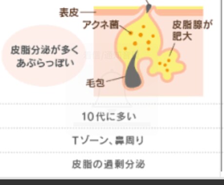 思春期ニキビの改善方法を提案します 中学生、高校生真っ赤な思春期ニキビにお困りの方 イメージ1