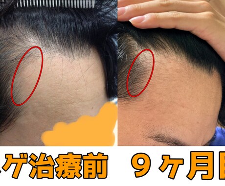 AGA治療歴3年！薄毛の悩みを解決致します プロの薄毛治療ライターである私が、あなたに最適な方法をご提案 イメージ2