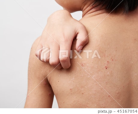 アトピー性皮膚炎の方相談のります 同じ悩みを持つ方居ませんか?ぜひ肩の荷を共有させて頂きたい。 イメージ1