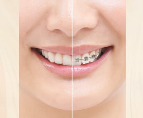マウスピース矯正□ぴったりの矯正方法は？□教えます 装置をほとんどつけないマウスピース矯正、ほんと？？ イメージ2